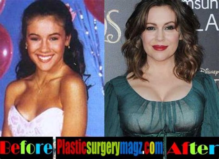 Alyssa Milano Plastic Surgery Before and After