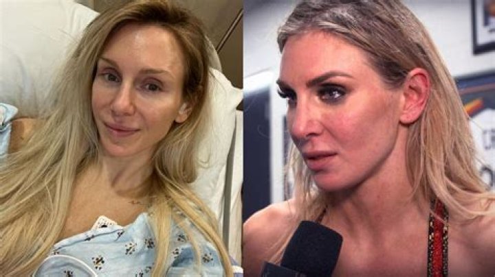 Charlotte Flair Plastic Surgery: Know the Cause Behind Charlotte's Absence from The Show!