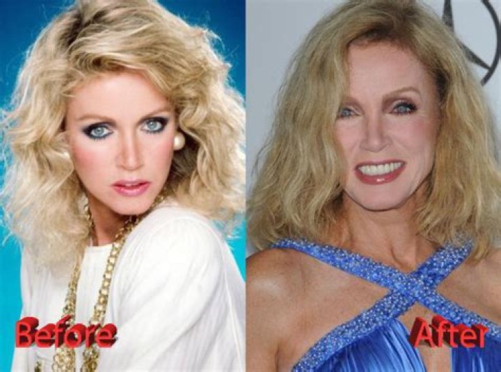 Donna Mills Plastic Surgery Before and After