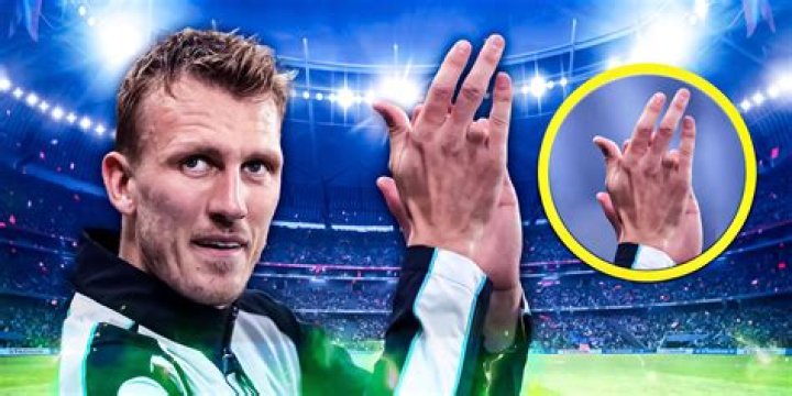 How did Bill lose his finger? – Celebrity