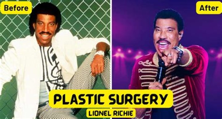 Lionel Richie Plastic Surgery: The Truth Behind the Plastic Surgery Speculations