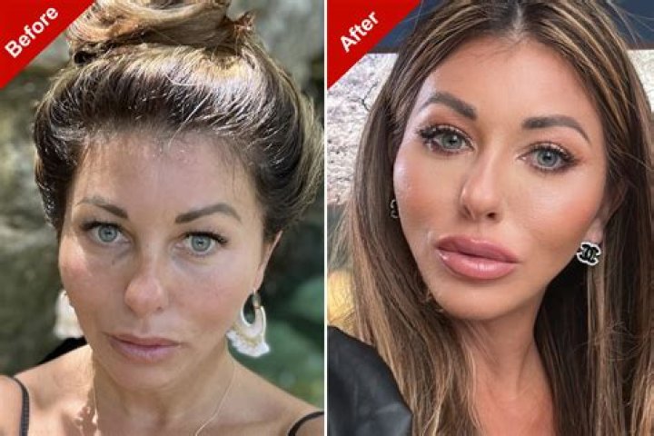 Lizzie Cundy Plastic Surgery: A Closer Look at Her Plastic Surgery Journey