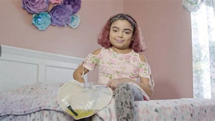 Meet Salma, the girl without stomach and intestines but still feed and alive