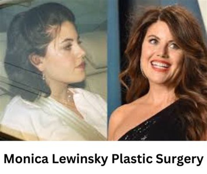 Monica Lewinsky Plastic Surgery: A Closer Look at the Evolution of Her Image