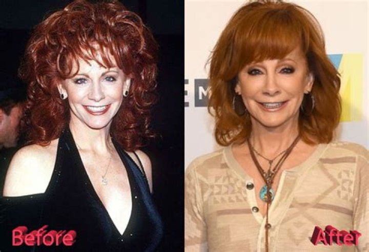 Reba McEntire Facelift Plastic Surgery Before and After