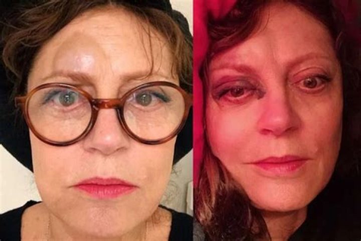 Susan Sarandon Shares Shocking Photos After Fall — Thelma And Louise Actress Suffered Concussion, Fractured Nose