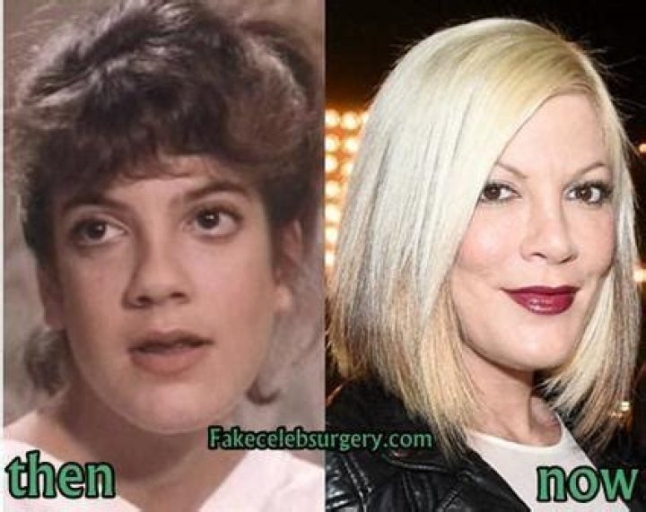 Tori Spelling Plastic Surgery Before and After